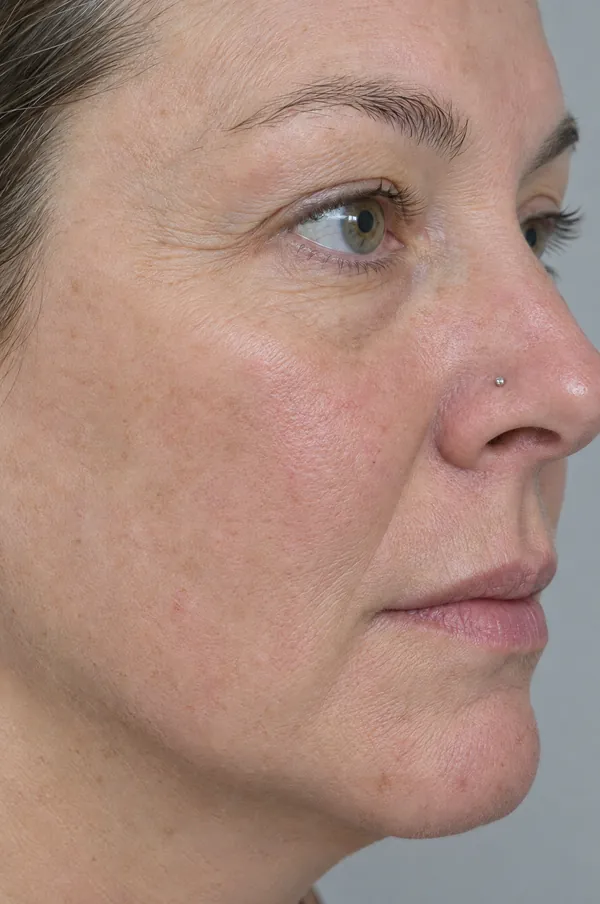 After: cheek and upper lip