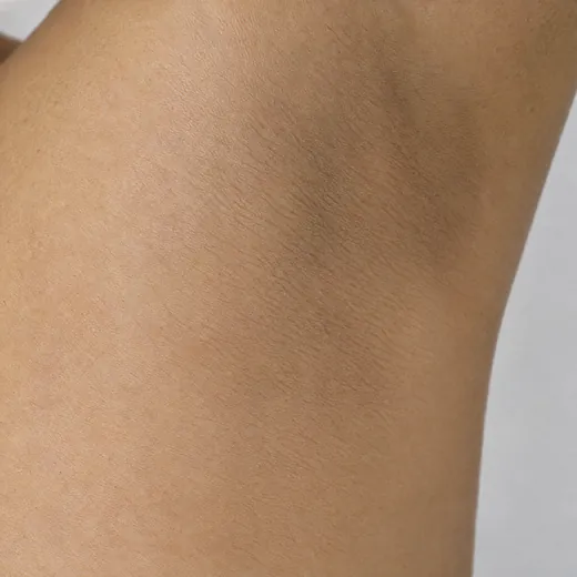 Illustrative: the same skin after a course of treatment